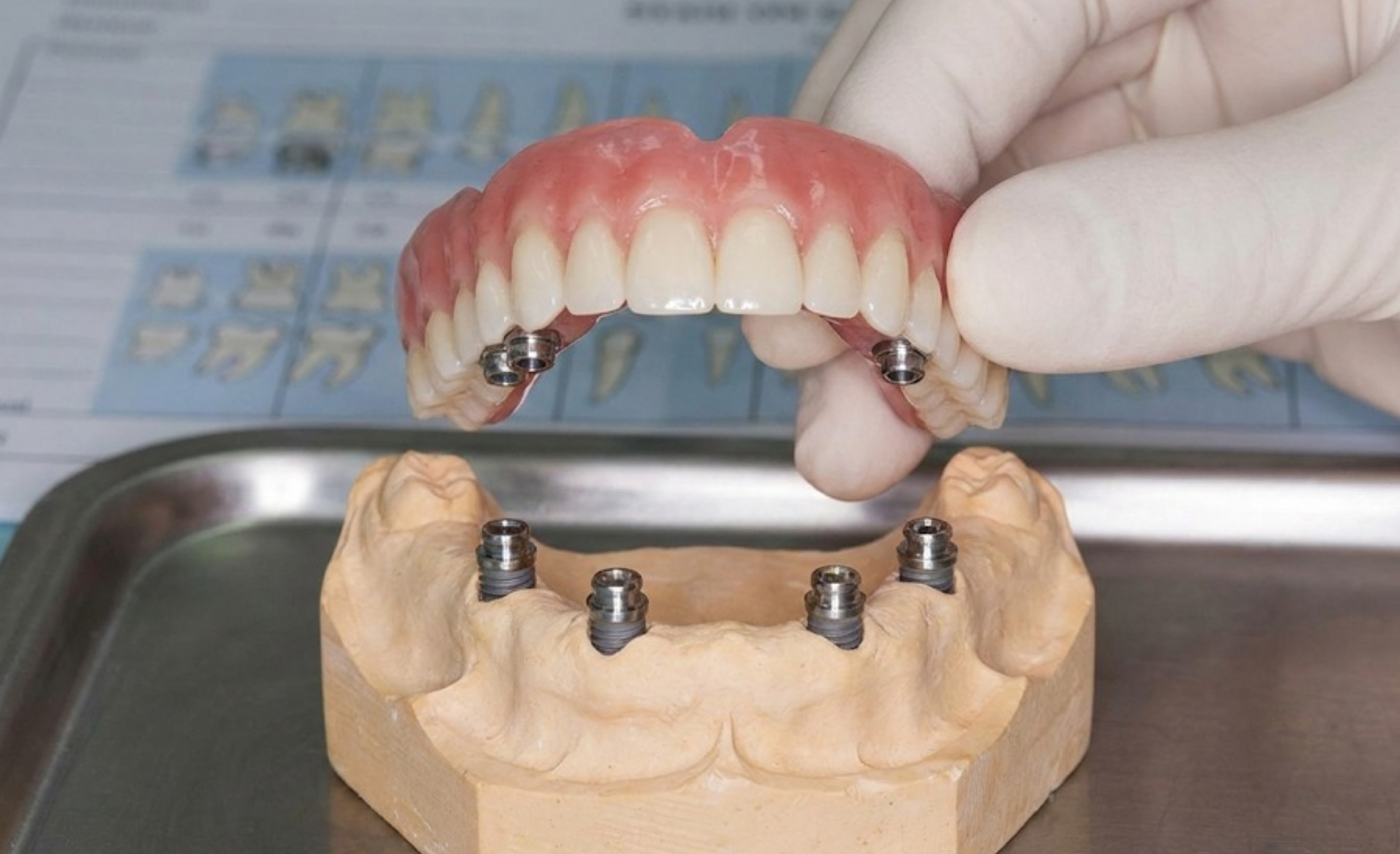 Implant Supported Overdentures